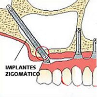 Odontólogos da Rússia e Espanha se especializam em Implantes Zigomáticos na AORP 